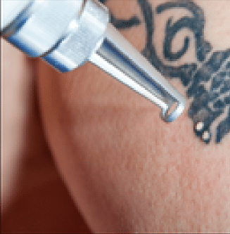 laseren-van-tattoos laseren van tattoos